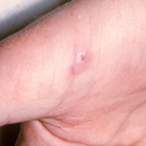 Symptoms of Cat Scratch Disease